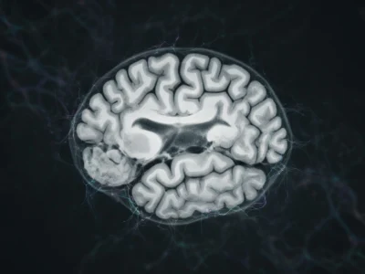 Représentation médicale d'un cerveau humain illustrant une atrophie cortico-sous-corticale visible