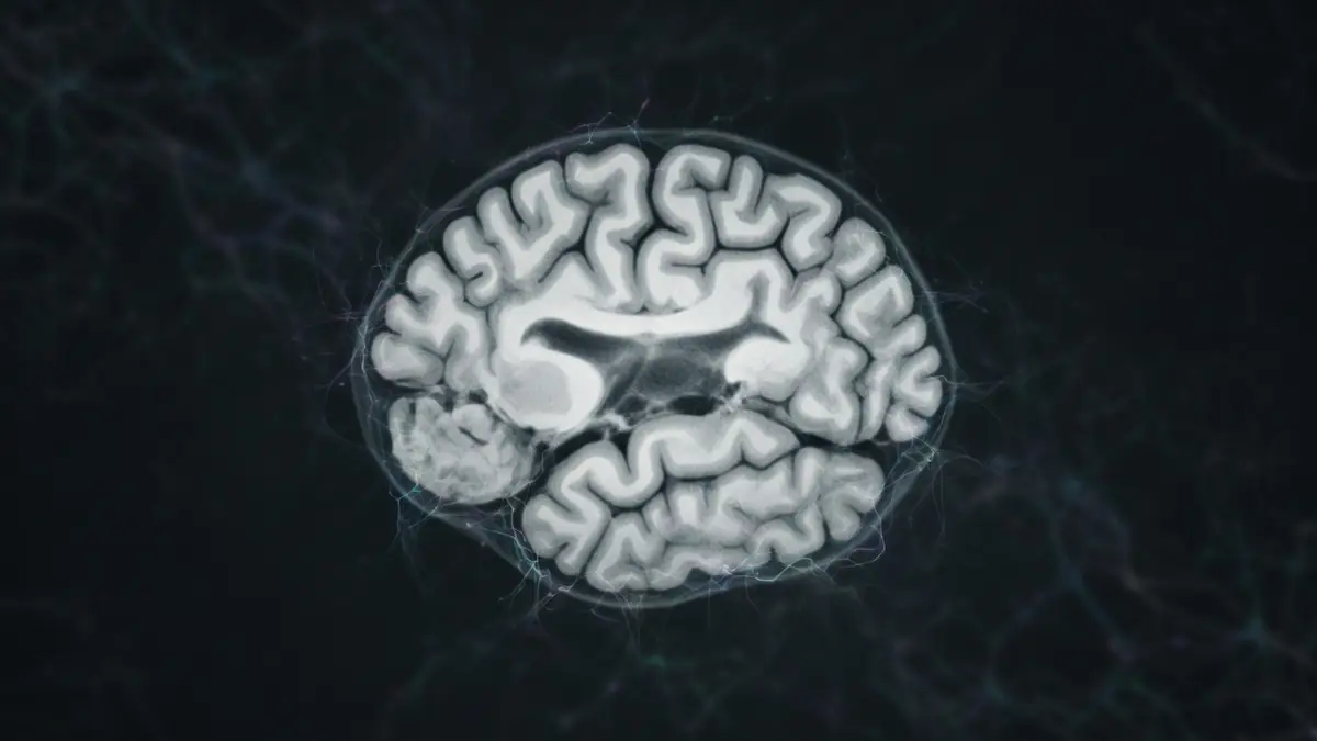 Représentation médicale d'un cerveau humain illustrant une atrophie cortico-sous-corticale visible