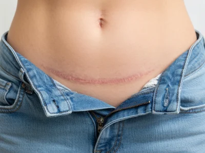 Une femme révèle sa cicatrice césarienne en baissant son jean sur l'abdomen