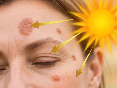 Visage d'une femme avec lésions de kératose actinique pointées vers le soleil