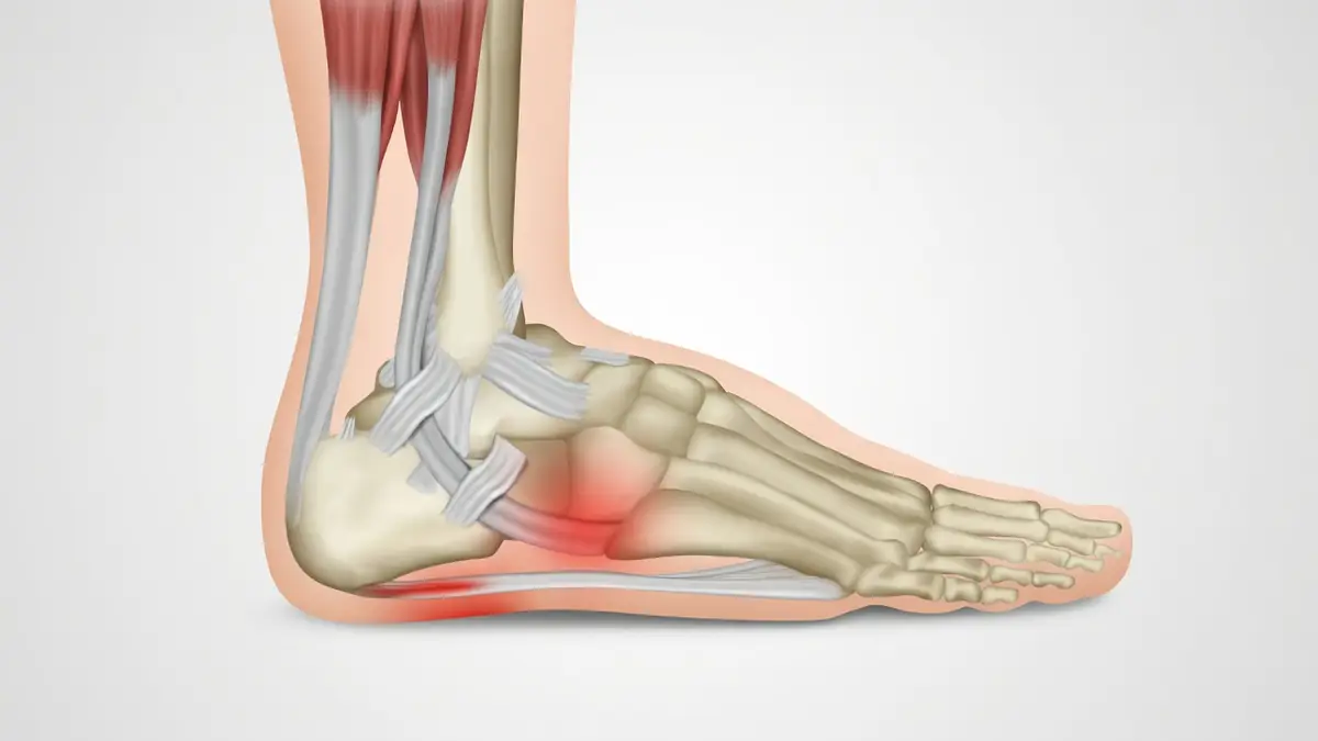 Illustration anatomique latérale du pied avec zones rouges signalant la douleur du talon