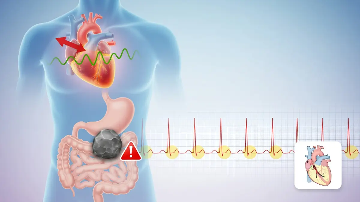 Schéma de la maladie de Bouveret associant anomalie cardiaque et calcul biliaire digestif