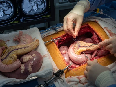 Chirurgiens réalisant une duodénopancréatectomie céphalique avec organes réséqués exposés