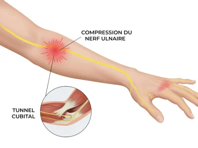 Vue anatomique d'un membre supérieur illustrant la compression du nerf ulnaire au coude et ses répercussions sur la main