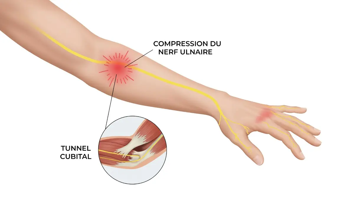 Vue anatomique d'un membre supérieur illustrant la compression du nerf ulnaire au coude et ses répercussions sur la main