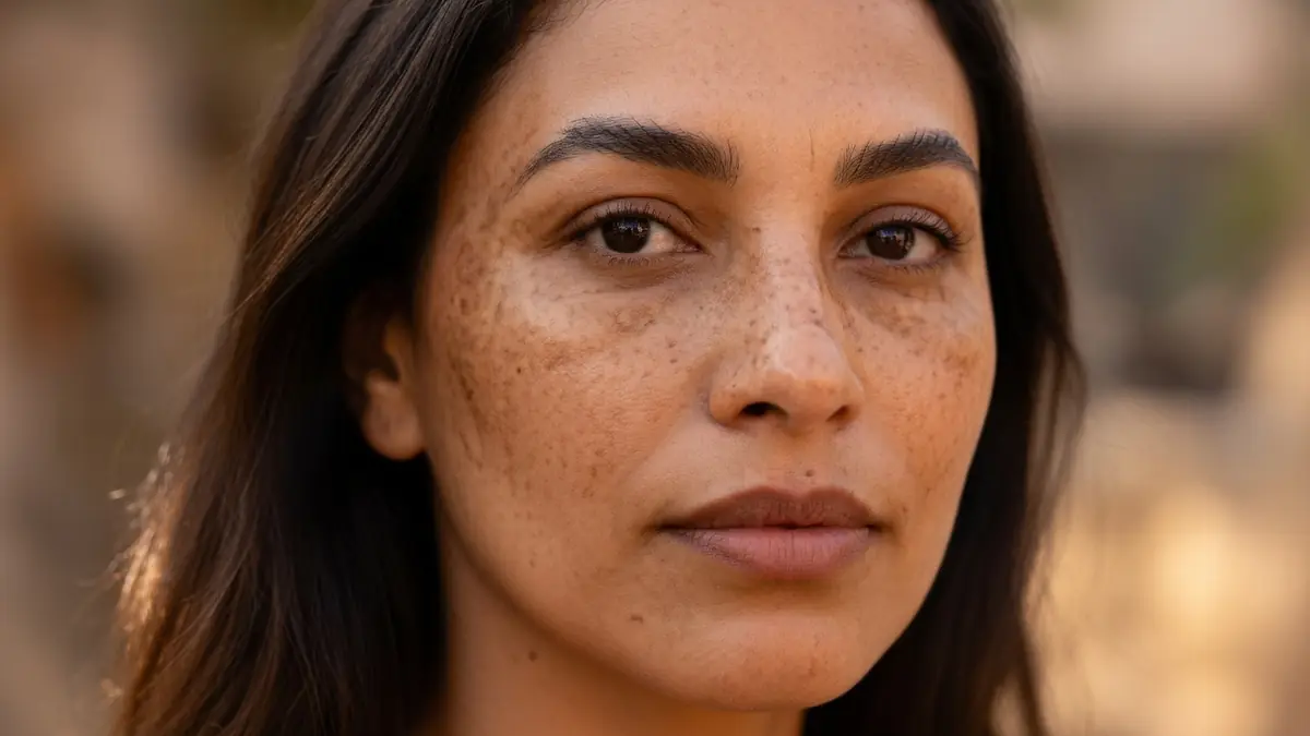 Portrait en gros plan d'une femme présentant des taches de pigmentation caractéristiques d'un masque de grossesse