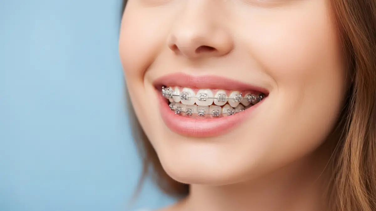 Gros plan sur un sourire féminin avec une bague sur les dents