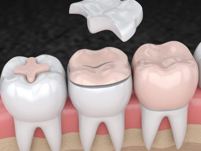 Schéma 3D montrant la pose précise d'un inlay dentaire sur une molaire pour restaurer la surface de la dent