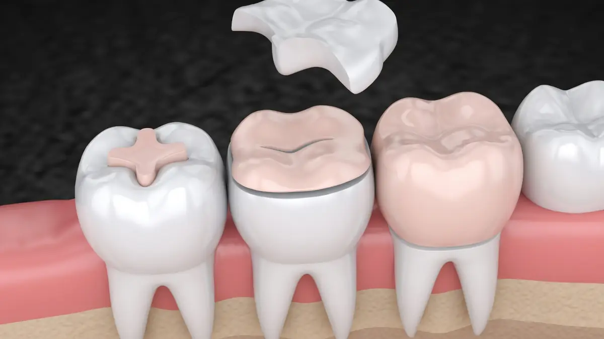 Schéma 3D montrant la pose précise d'un inlay dentaire sur une molaire pour restaurer la surface de la dent