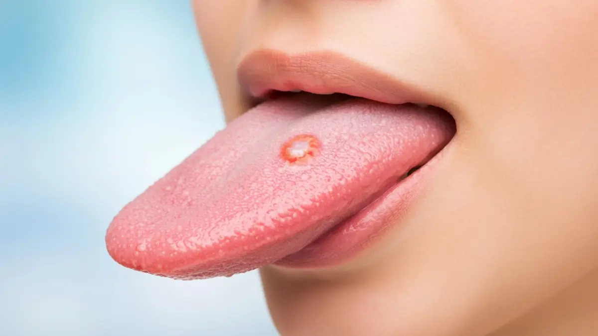 Un supplice en mouvement : comprendre et soulager les aphtes sur la langue