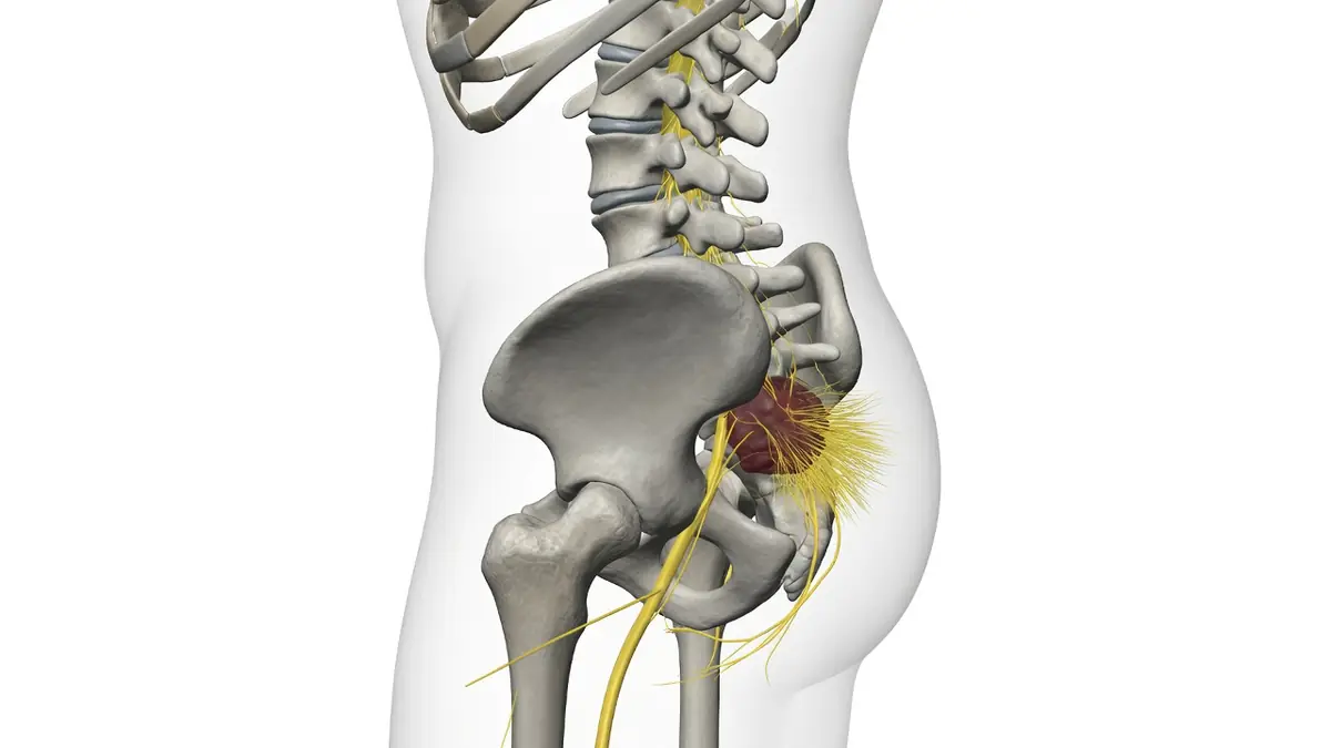 Représentation anatomique du syndrome de la queue du cheval dans le bas du dos